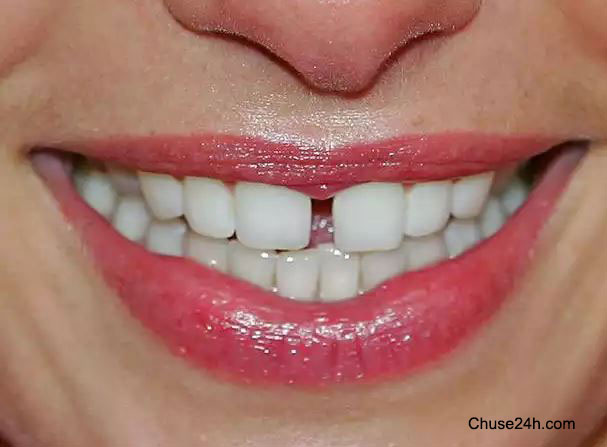 Lười đánh răng có thể gây mất trí nhớ