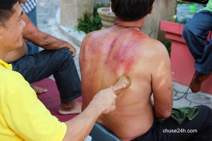 Lưu ý khi cạo gió, không cẩn thận có thể gây chết người - 第1张