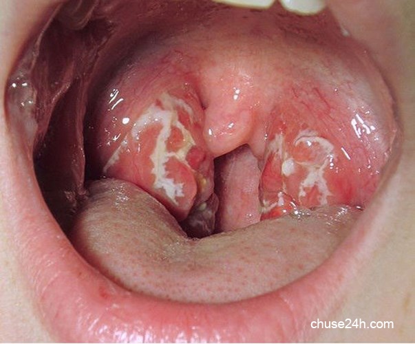 Ung thư vòm họng căn bệnh ung thư khó phát hiện