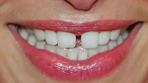 Lười đánh răng có thể gây mất trí nhớ