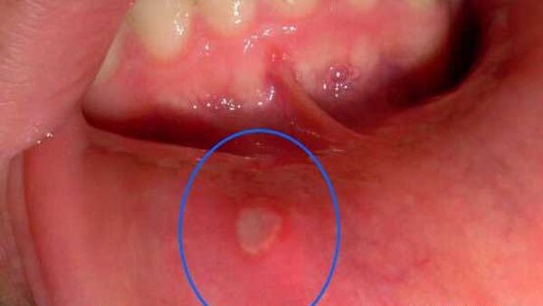 Cách trị nhiệt miệng bằng các loại rau