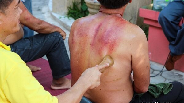 Lưu ý khi cạo gió, không cẩn thận có thể gây chết người